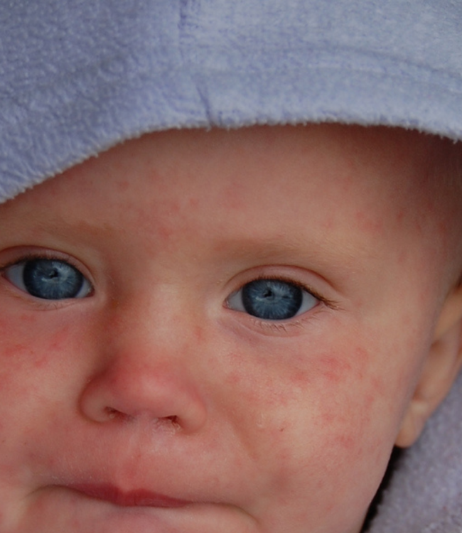 peau, eczéma, produit naturel, sensibilité, digestion, foie, nettoyage, picotement