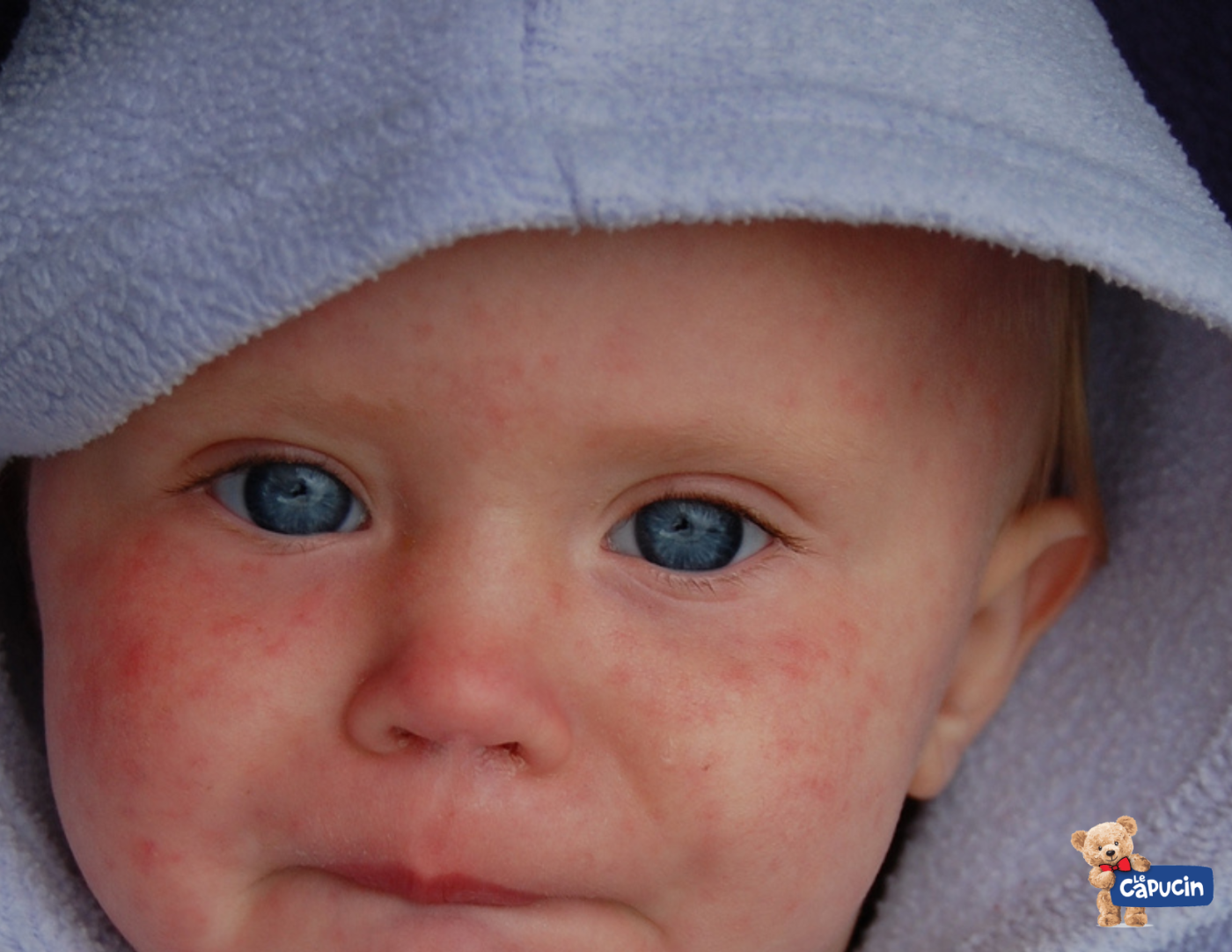 peau, eczéma, produit naturel, sensibilité, digestion, foie, nettoyage, picotement